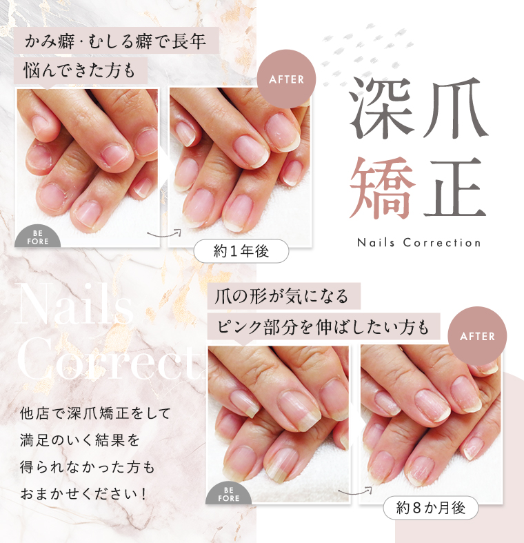 深爪矯正|かみ癖・むしる癖で長年悩んできた方、爪の形が気になる、ピンク部分を伸ばしたい方もおまかせください！