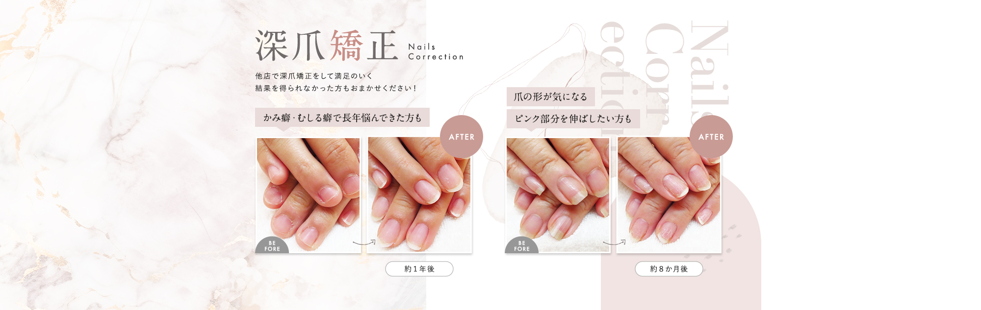深爪矯正|かみ癖・むしる癖で長年悩んできた方、爪の形が気になる、ピンク部分を伸ばしたい方もおまかせください！